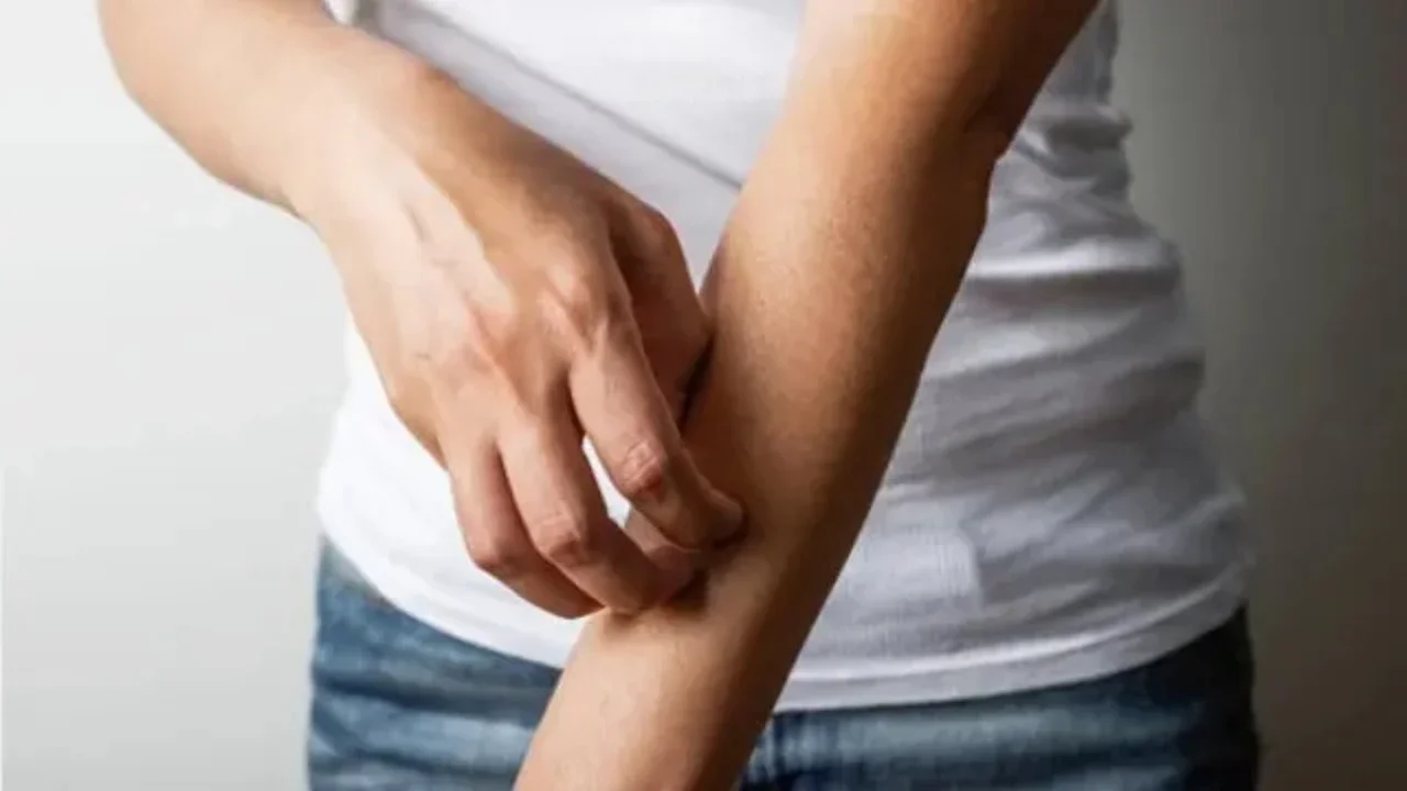 Cara Ampuh Menghilangkan Gatal Akibat Bulu Ulat Tanpa Obat, Bisa Dicoba