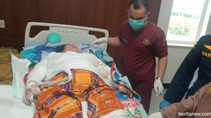 Latest Update: Luka Parah Akibat Terbakar, Jari Tangan Korban Selamat Kecelakaan Bus ALS-Truk Tangki Terancam Diamputasi